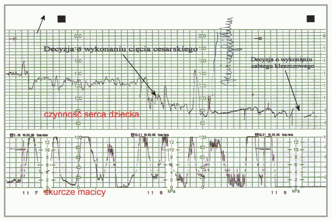 Jak czytać zapis KTG na monitorze i zrozumieć zdrowie płodu