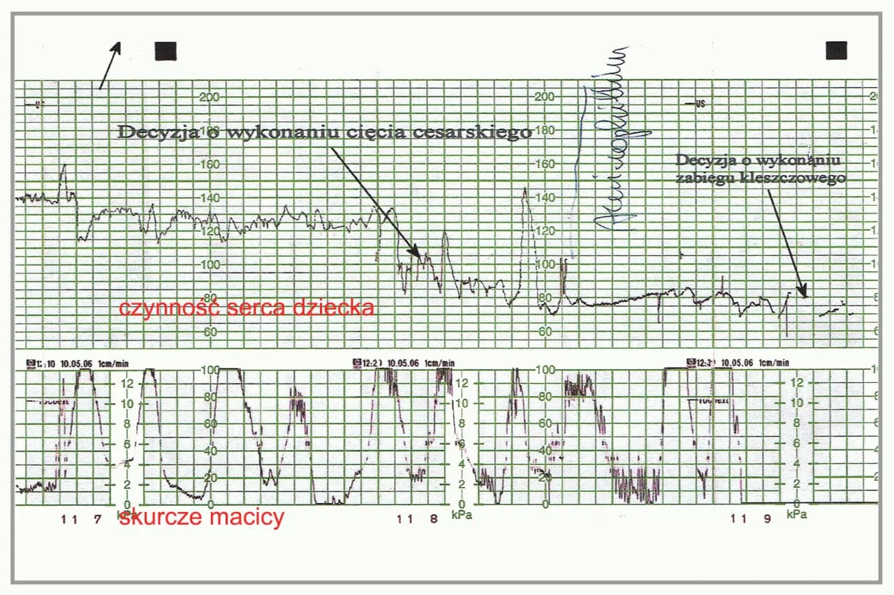 Jak czytać zapis KTG na monitorze i zrozumieć zdrowie płodu